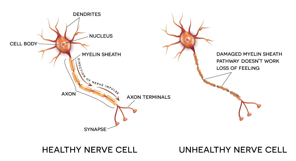 Neuropathy Treatment Pittsburgh